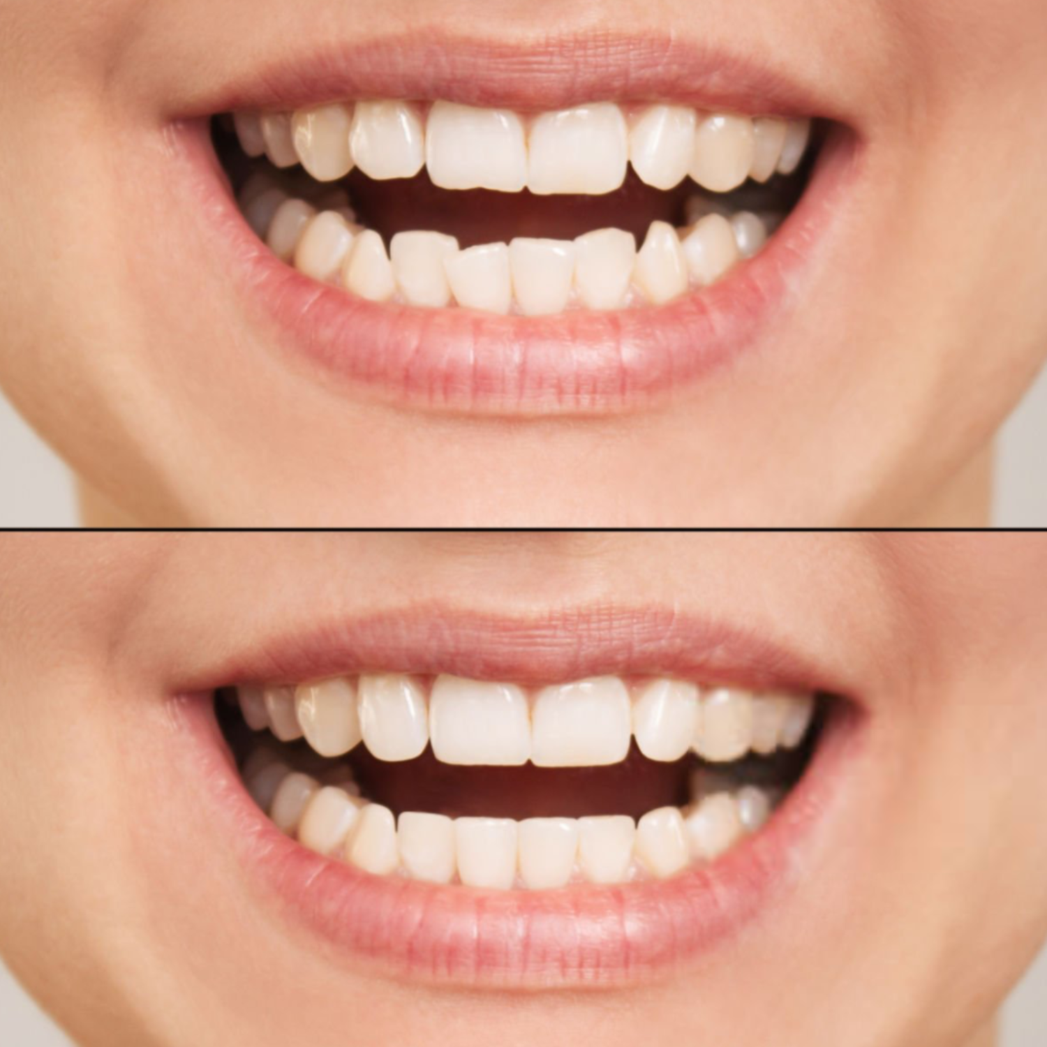 If composite bonding is selected