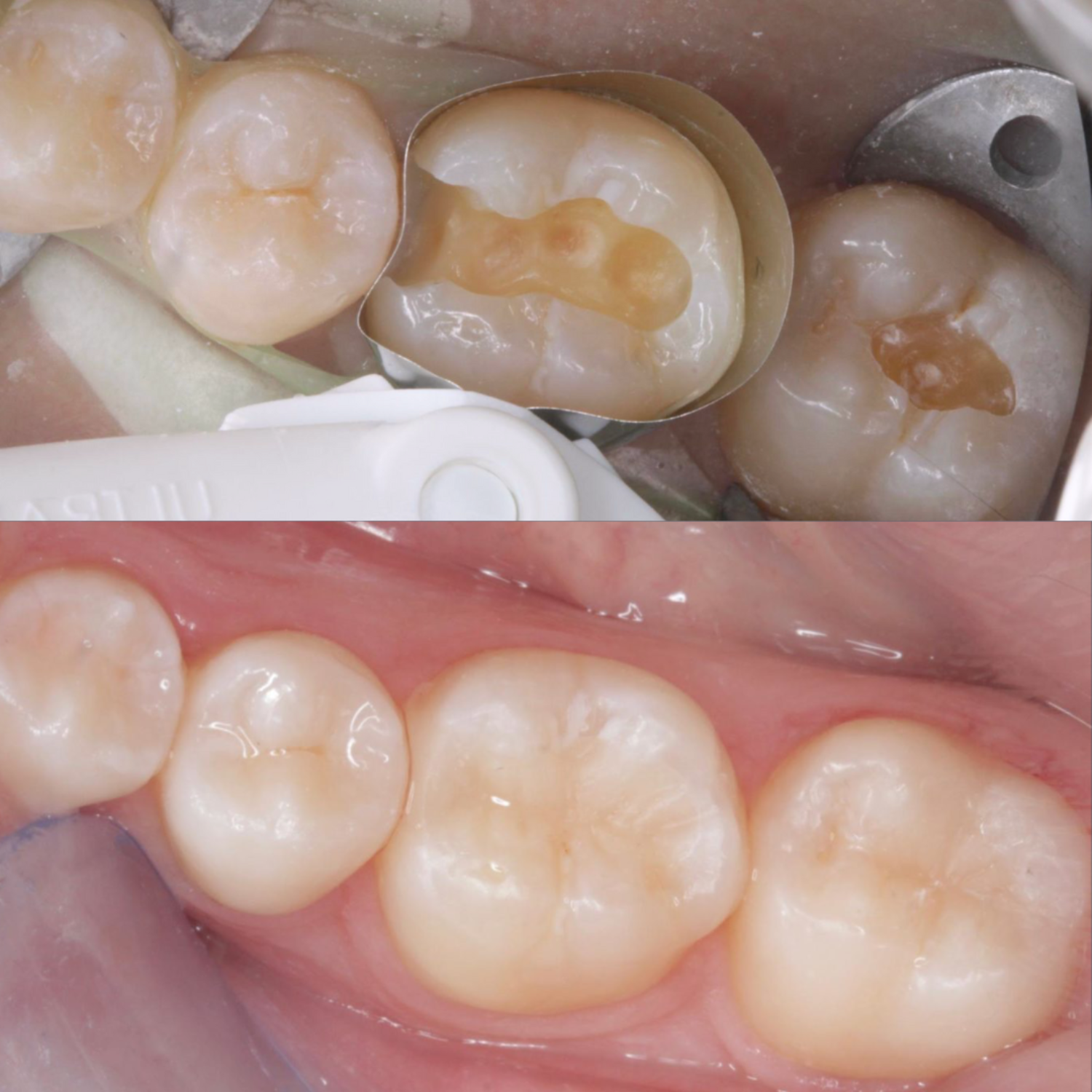 Why Composite Fillings?