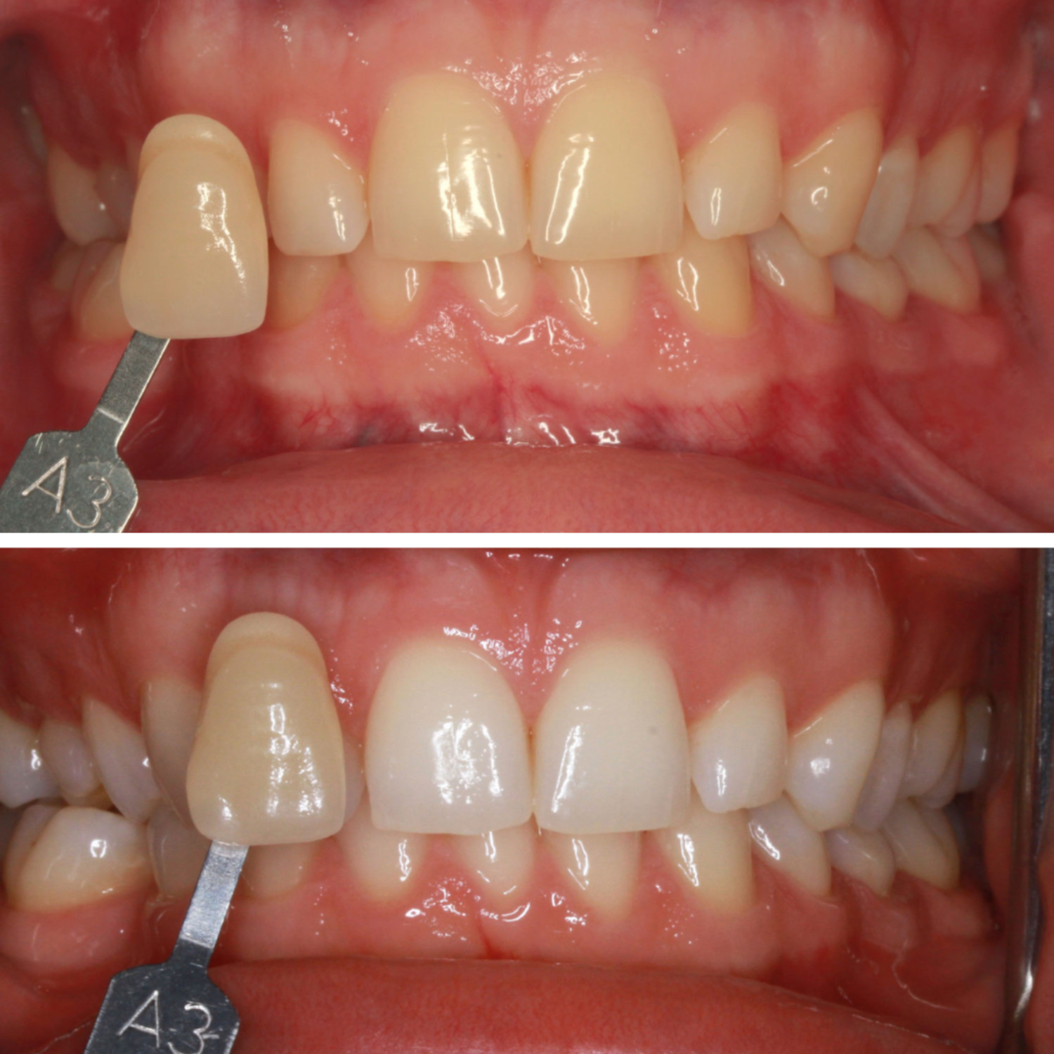 WHICH TEETH WHITENING METHOD IS RIGHT FOR YOU?