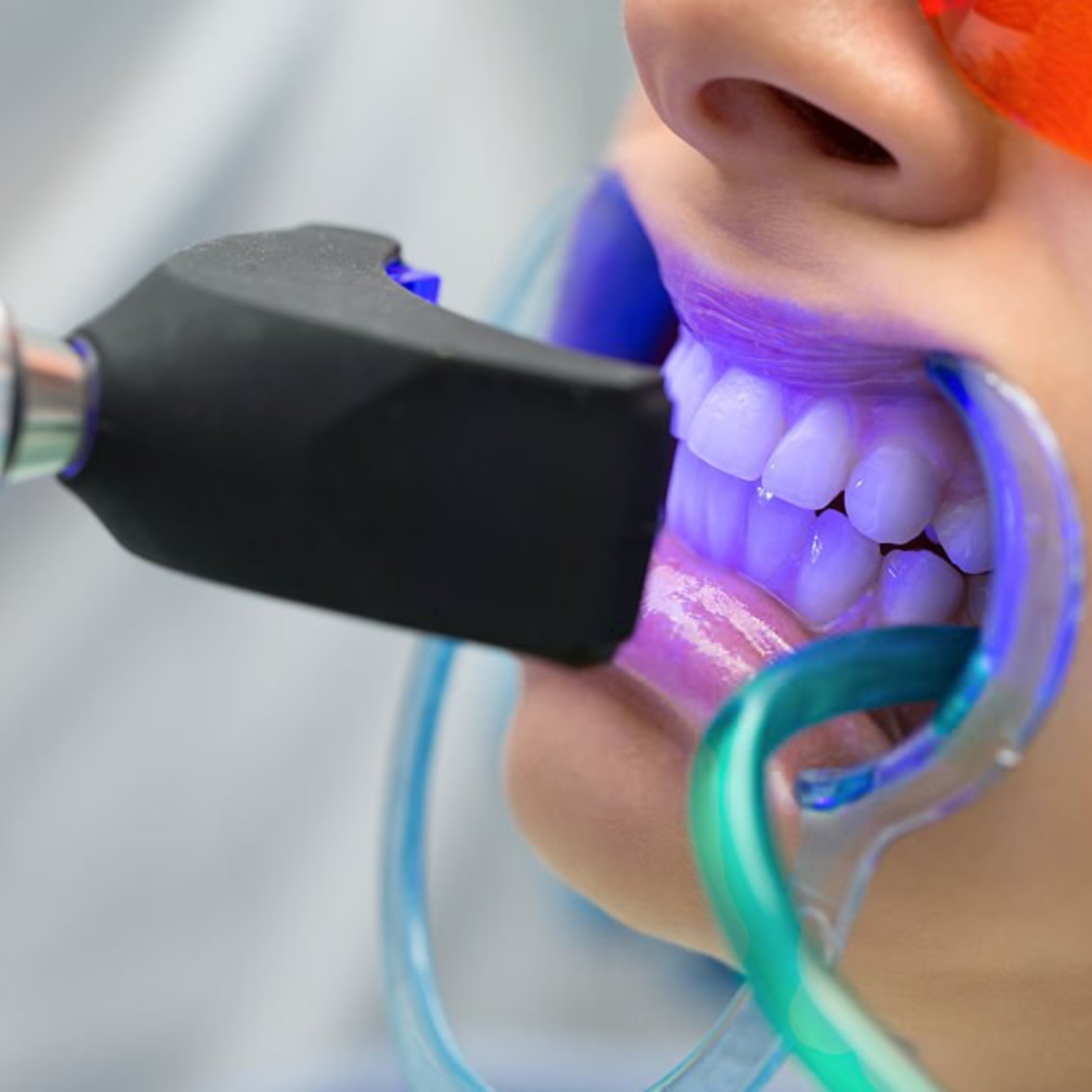 HOW DO DENTISTS WHITEN TEETH?