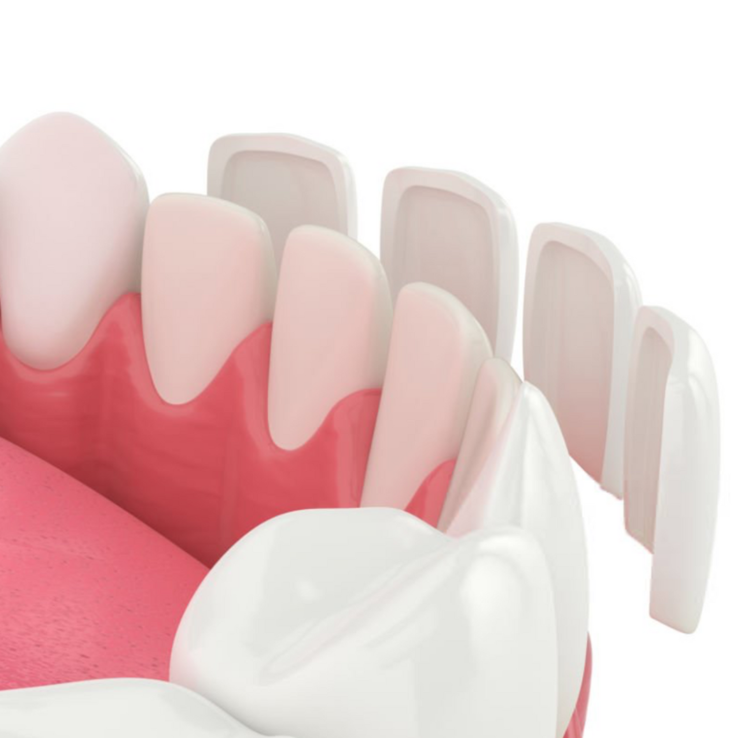 What is an intra-oral mock-up?
