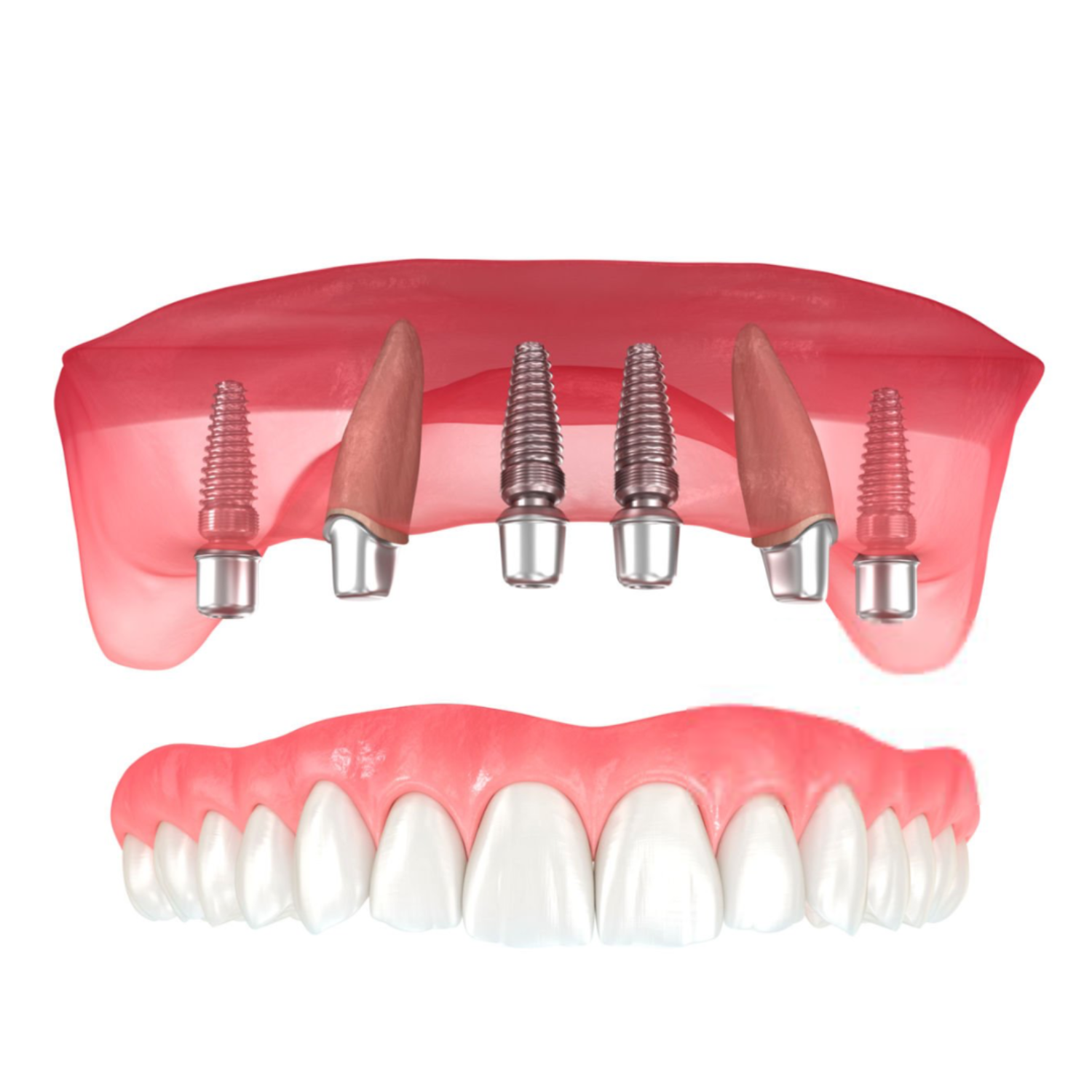 3. Overdentures
