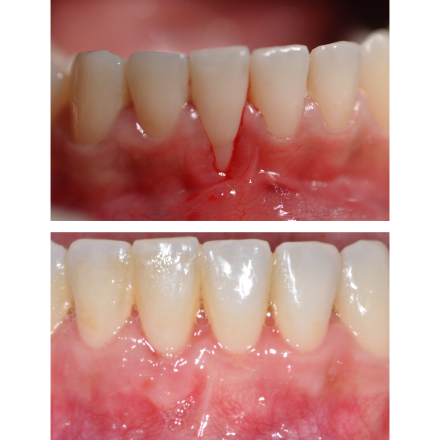 Symptoms That May Indicate the need for Periodontal Treatment