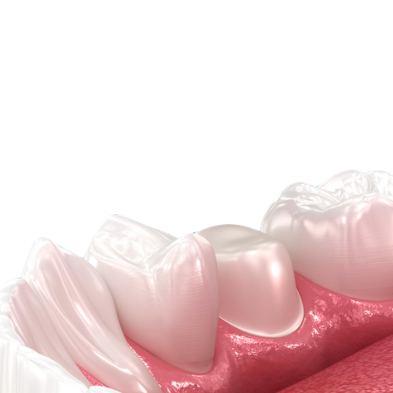 Tooth preparation