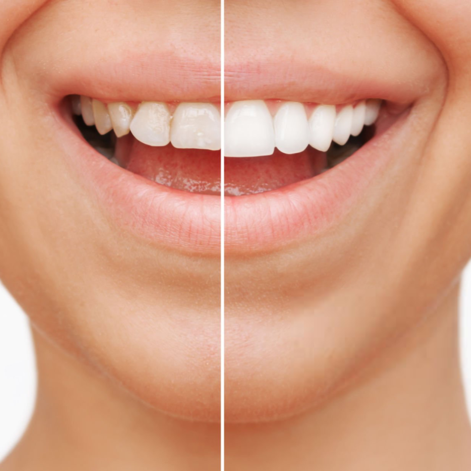 Considering Veneers or Crowns in London?