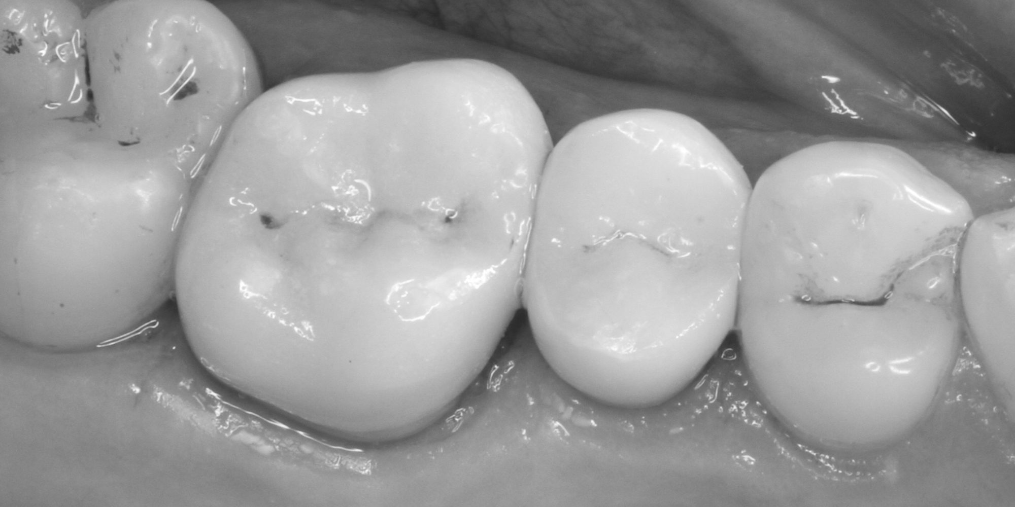 Can you spot the two ceramic crowns?